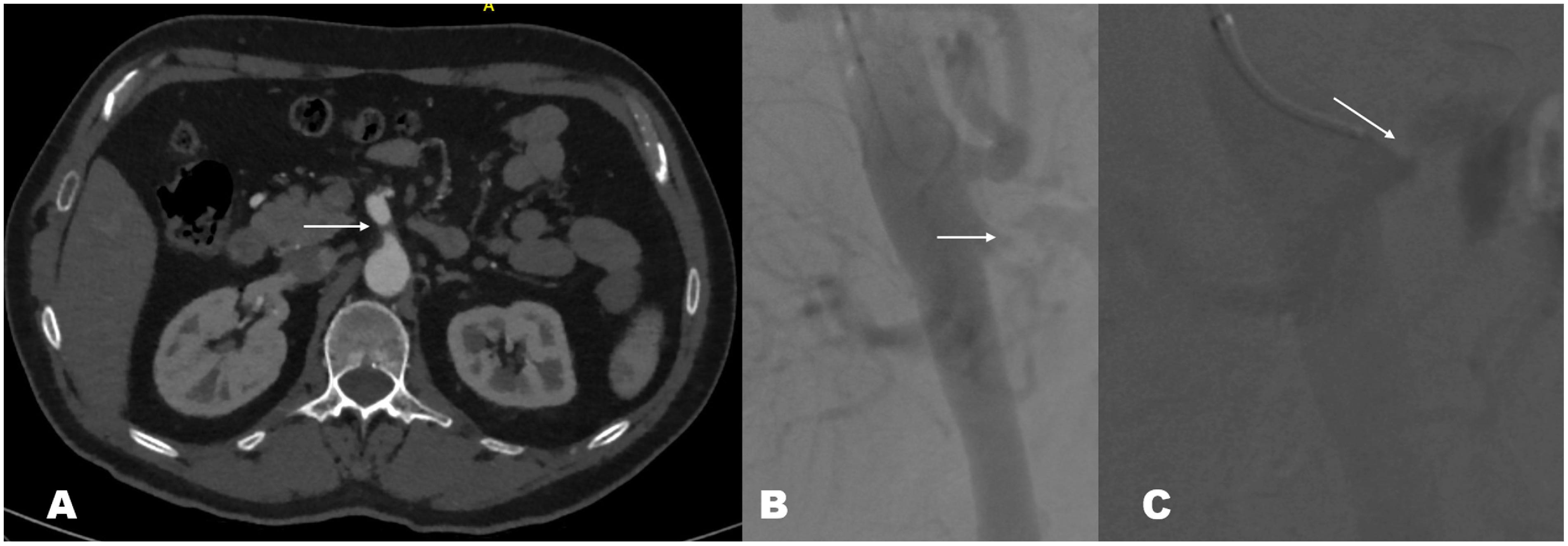 Fig. 2 (A) Computed tomography angiography showing a stenosed superior mesenteric artery with distal perfusion. There is no embolus nor atherosclerotic changes surrounding the lesion. (B) Nonselective angiography showing isolated superior mesenteric artery dissection (ISMAD). (C) Selective angiography showing ISMAD.