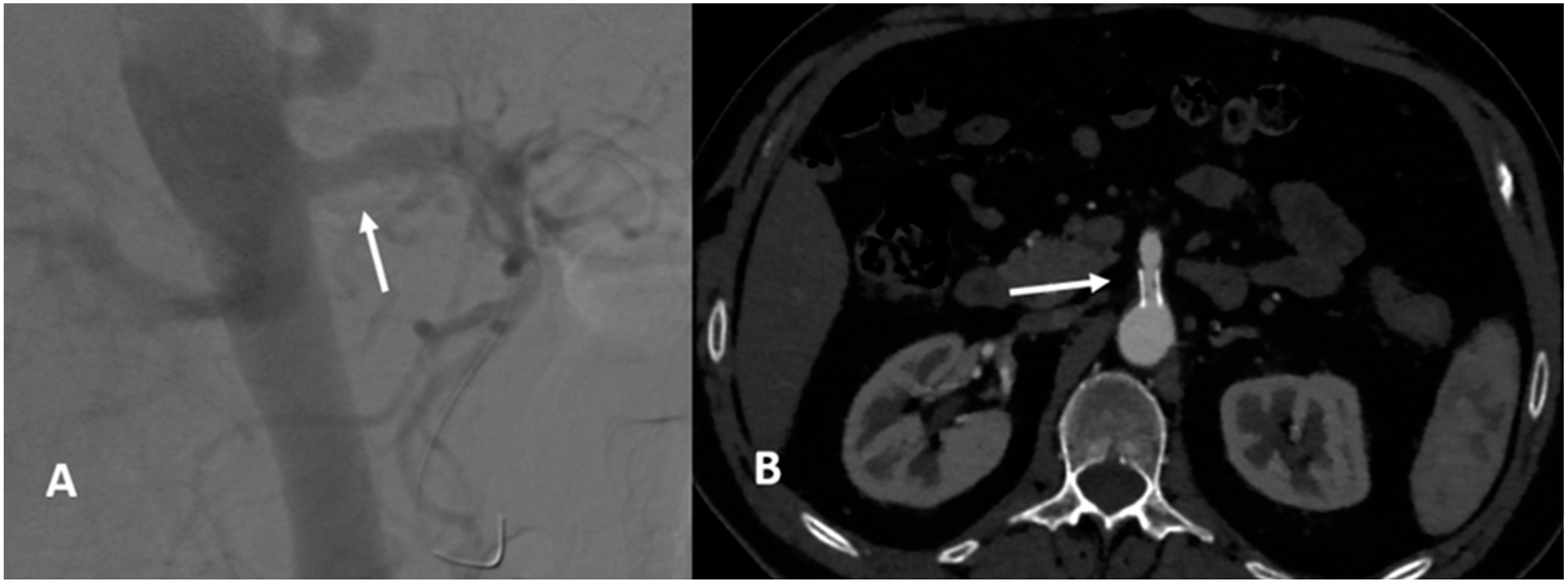 Fig. 3 (A) Angiography post-stenting showing patent superior mesenteric artery (SMA). (B) computed tomography angiography 6 months post repair. The SMA is patent, but there is evidence of minimal intimal hyperplasia.