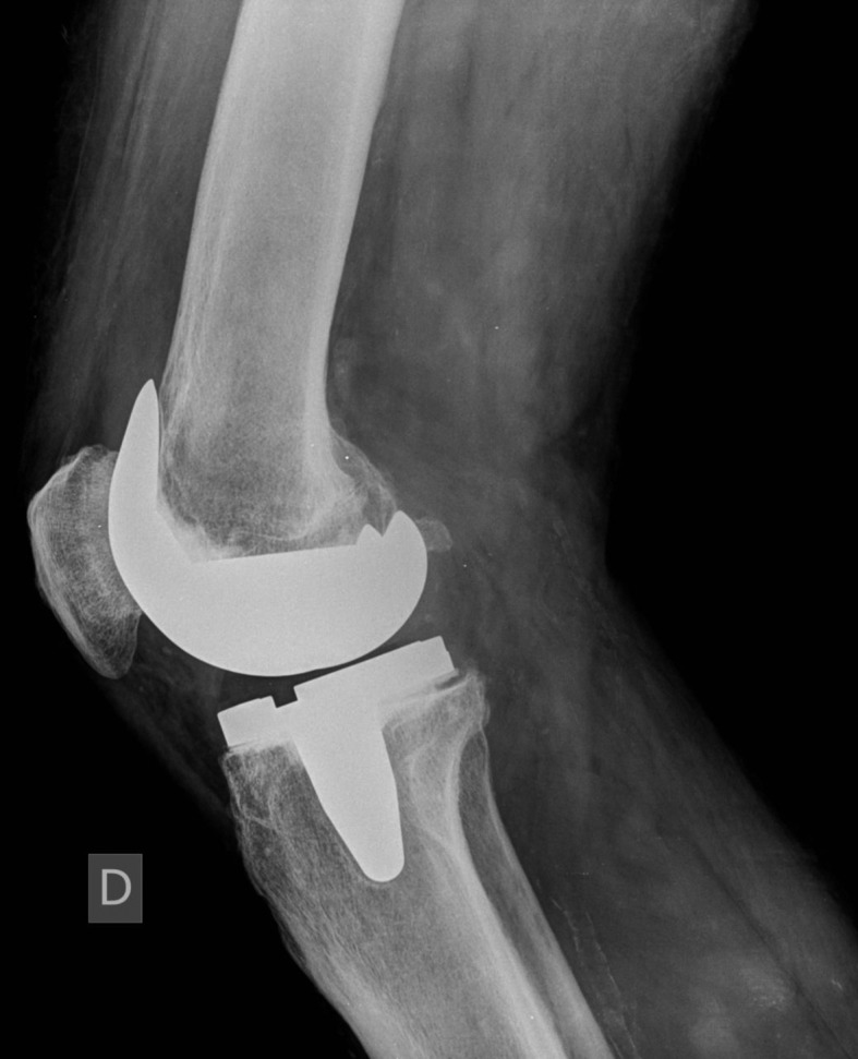 Early experience with the ATTUNE Total Knee Replacement System - PMC