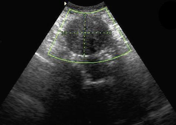 Pedunculated uterine leiomyoma mimicking abdominal mass: a case report ...