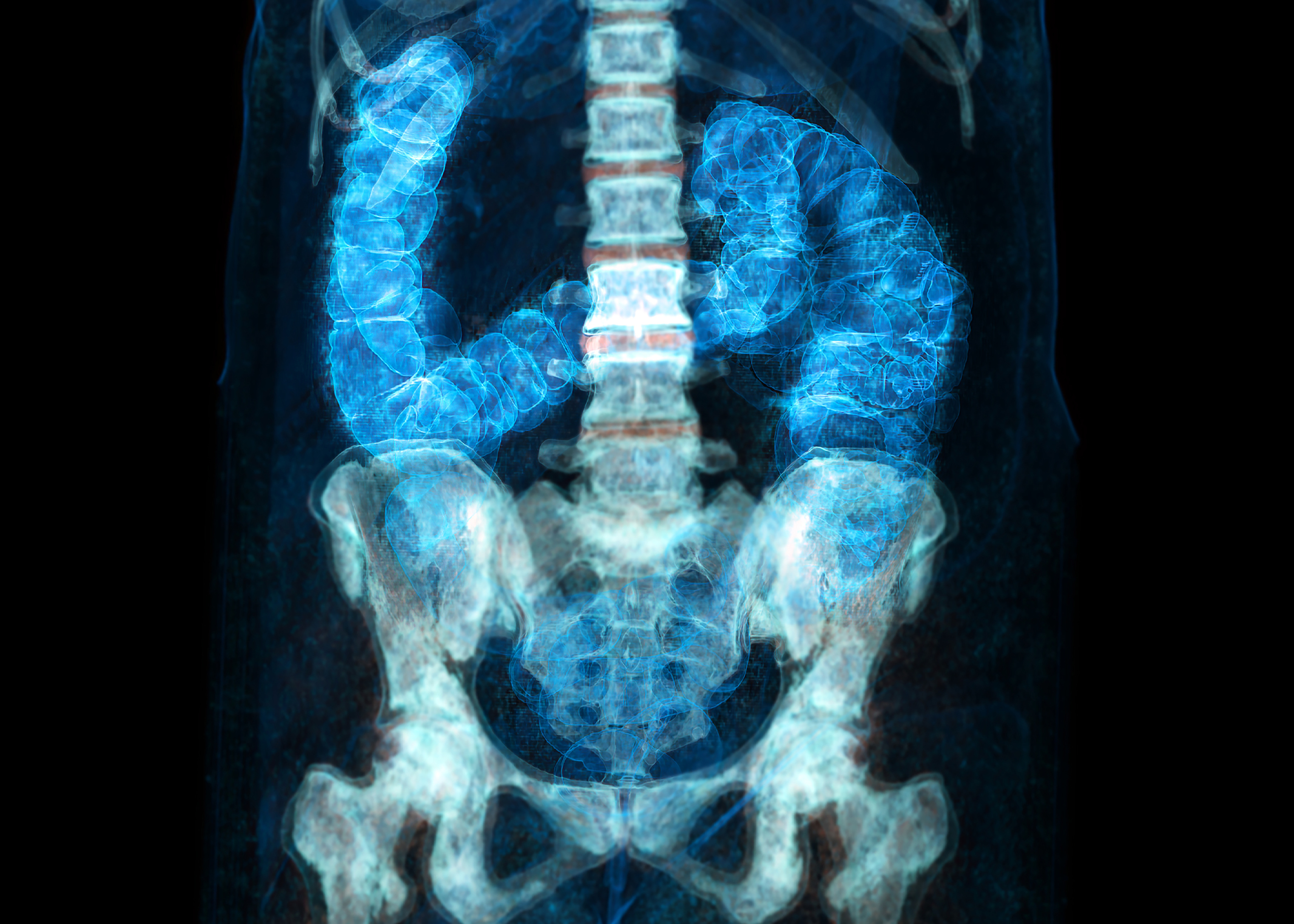 Computed tomography scan of a human torso, showing ribs, spine, pelvis, and thigh bones in bluish white and large intestine in bright blue, against black background