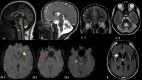 Magnetic resonance imaging of the brain of selected patients