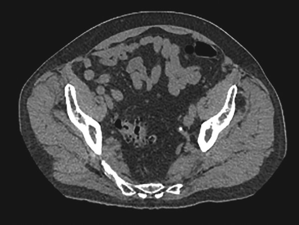 Combined pantaloon and femoral hernia: a common pathology in medicine ...