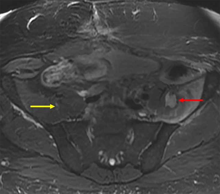 Axial T2-weighted MR image in a 46-year-old male patient with a post–microwave ablation femoral nerve injury. The femoral nerve on the treated side could not be separated from the tumor (red arrow). The location of the femoral nerve on the contralateral side (yellow arrow) is noted for comparison.