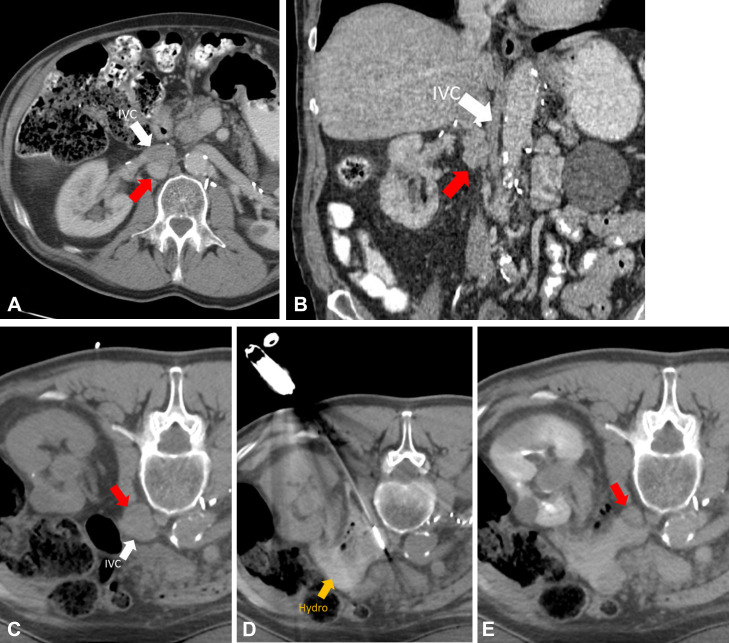 CT scans in a 67-year-old male patient with metastatic pheochromocytoma to the retroperitoneum. (A, B) Preprocedural CT scans demonstrate metastatic lymph node (red arrows, 2.4 × 2.0 × 3.7 cm) immediately posterior to the inferior vena cava (IVC; white arrows). (C) Patient in the prone treatment position demonstrating nodal target (red arrow). (D) One of two microwave ablation antennas in place after hydrodissection fluid was placed in the retroperitoneum (Hydro; yellow arrow). Treatment was performed for 5 minutes at 65 W. (E) Immediate postprocedural scan with intravenous contrast material. Note shrinkage of node (red arrow) after microwave ablation due to tissue dehydration.