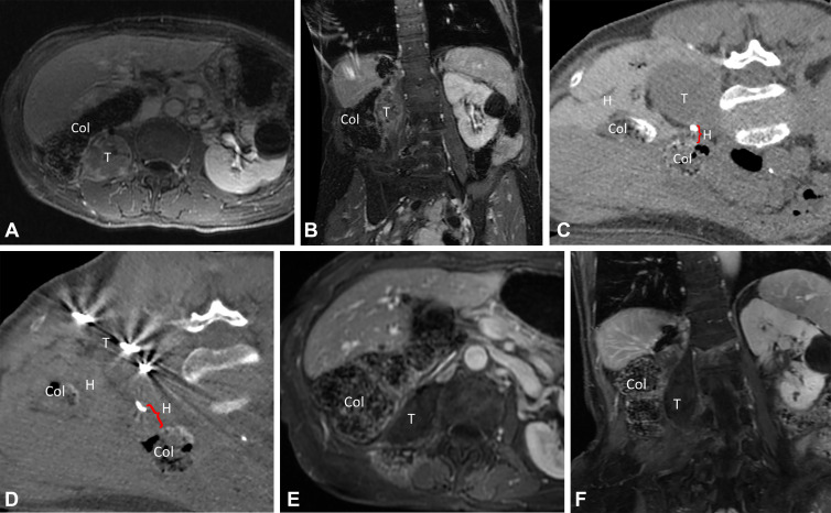 Images in a 73-year-old female patient with a 4.5-cm metastatic adrenal oncocytic neoplasm to the retroperitoneum. (A, B) Pretreatment contrast-enhanced MR images in the (A) axial and (B) coronal planes. Note the proximity of the colon to the tumor, putting the patient at risk for colonic injury with thermal ablation without displacement. (C) Intraprocedural CT image in patient in prone treatment position before antenna placement. The colon has been partially displaced from the tumor by the injection of hydrodissection fluid (0.9% saline mixed with 2% iohexol) under US guidance. (D) Intraprocedural CT image obtained after placement of three microwave ablation antennas and injection of more hydrodissection fluid. Note the further displacement of the colon away from the tumor, increasing the safety of thermal ablation. (E, F) Nine-month posttreatment contrast-enhanced MR images in the (E) axial and (F) coronal planes demonstrate no residual tumor enhancement or tumor shrinkage and no evidence of colonic injury. Col = colon, H = hydrodissection, T = metastatic adrenal oncocytic neoplasm.