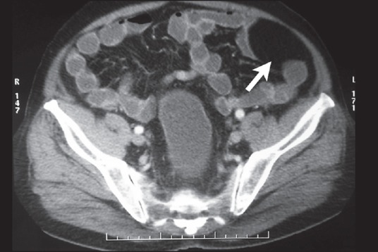 Laparoscopic excision of a lipoma of parietal peritoneum - PMC