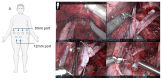 Robotic left renal vein transposition for nutcracker syndrome