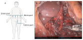 Robotic median arcuate ligament release