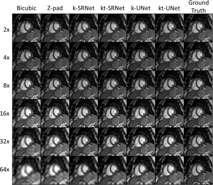 Representative example images in a 62-year-old man for comparison of super-resolution methods across multiple upsampling factors. Neural network–based methods had a pronounced effect at upsampling by a factor of eight or more. k = single frame, kt = multiframe, Z-pad = zero padding.