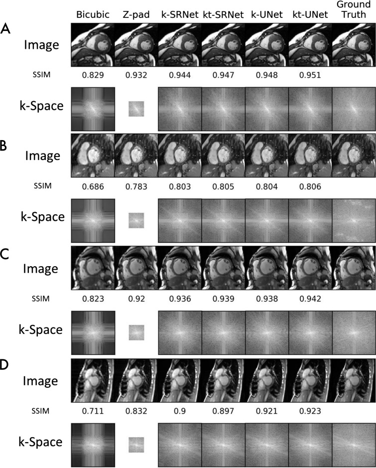 Example images compare super-resolution methods at upsampling by a factor of eight. Output images and corresponding log plots of k-space are shown along with the structural similarity index (SSIM) relative to ground truth. At 1.5 T, neural network methods, A, perform well in a 36-year-old male patient with hypertrophic cardiomyopathy and, B, serendipitously repair severe radiofrequency artifact in the outer k-space in a 44-year-old female patient. At 3.0 T, neural network methods, C, perform well in a 54-year-old female patient with dilated cardiomyopathy and, D, tolerate artifacts from sternal wires in a 28-year-old female patient. k = single frame, kt = multiframe, Z-pad = zero padding.