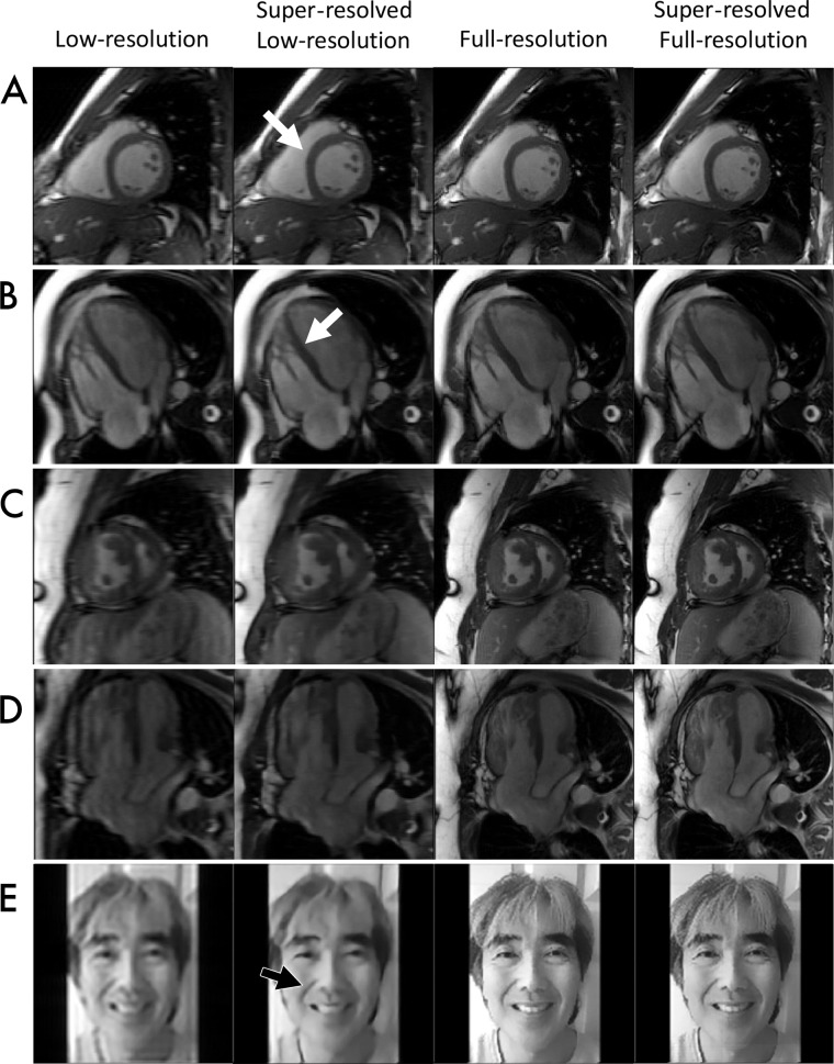 Images demonstrate proof-of-concept assessment of super-resolution methods. Low-resolution input, full-resolution reference, and k-UNet super-resolved images are shown for five experiments: A, short-axis cine steady-state free precession (SSFP) in a 27-year-old healthy male volunteer at 3.0 T, B, four-chamber cine SSFP in a 26-year-old healthy male volunteer at 3.0 T, C, short-axis cine SSFP in a 36-year-old patient with transposition of the great arteries after Mustard switch, D, four-chamber cine SSFP in the same patient as in, C, and, E, photographs of a human face. The k-UNet network appears to improve myocardium–blood pool delineation, especially along the septal wall. Although trained only with short-axis images, the k-UNet network appears to generalize to long-axis images and digital photographs, sharpening details. This network also appears to further enhance detail of low-resolution images and full-resolution reference acquisitions.