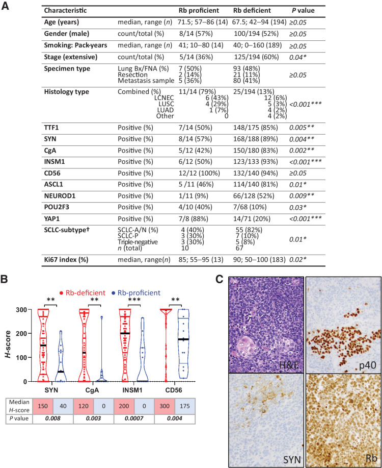 Figure 3. Clinicopathologic characteristics of Rb-proficient compared with Rb-deficient SCLC. A, Demographic, histopathologic, and IHC characteristics (†) SCLC subtypes were assigned only to cases with data available for ASCL1, NEUROD1, and POU2F3. SCLC-A/N: tumor with expression of ASCL1 and/or NEUROD1. SCLC-P: tumors expressing exclusively POU2F3. Triple-negative: tumors lacking ASCL1, NEUROD1, and POU2F3 expression. B, Violin dot plots showing the quantitative distribution of H-scores for conventional neuroendocrine marker expression in Rb-proficient versus Rb-deficient SCLC. C, Example of a combined SCLC (top component: p40−, SYN+) with LUSC (bottom component: p40+, SYN−; bottom left: keratin pearl) showing retained Rb expression in both components. Statistical significance: *, P < 0.05; **, P < 0.01; ***, P < 0.001; not significant, P ≥ 0.05.