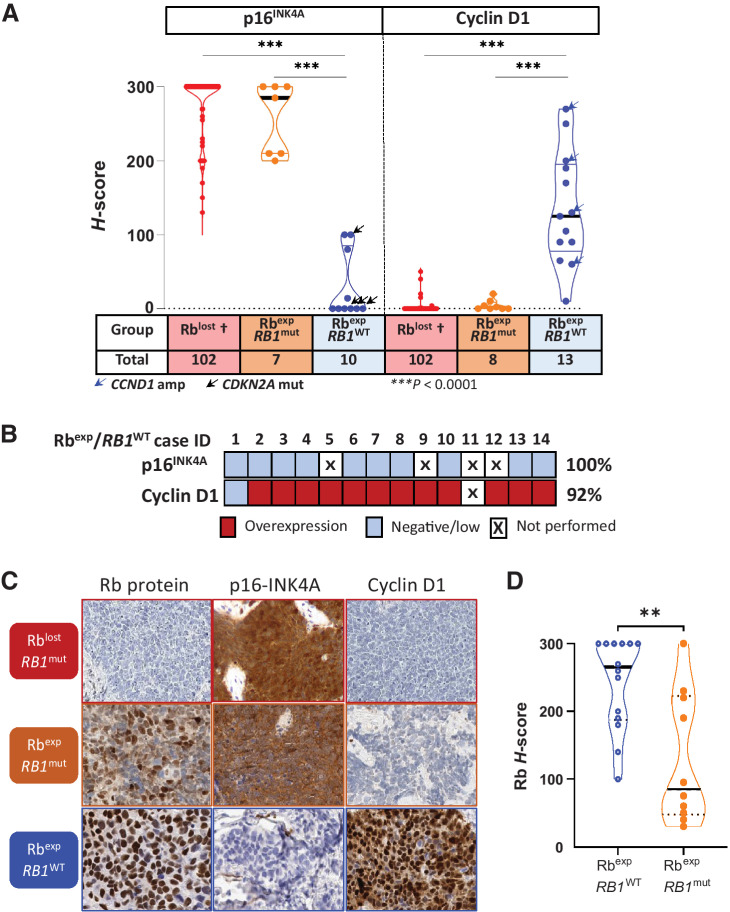 Figure 2. p16 and cyclin D1 as ancillary markers of Rb functional status. A, Violin dot-plot graph depicting p16 and cyclin D1 H-scores in relation to groups defined by Rb expression and RB1 alterations, and demonstrating a consistent p16high/cyclin D1low profile for Rblost and Rbexp/RB1mut tumors, whereas all Rbexp/RB1WT tumors demonstrated the opposite p16low profile, with cyclin D1high in most cases. †, Rb-lost group in this analysis included 25 cases from the current cohort and 77 cases from TMAs (see Materials and Methods). Statistical significance: ***, P < 0.0001. B, Heatmap of Rbexp/RB1WT cases summarizing the incidence of p16low (H-score ≤ 100) and cyclin D1high (H-score ≥ 50), with the thresholds defined using the distribution of scores in Rb-lost SCLC (see Supplementary Table S1). C, Photomicrographic examples of Rb, p16 and cyclin D1 profiles in SCLC groups defined by Rb expression and RB1 alterations. D, Violin dot-plot graph showing H-scores of Rb immunoexpression in RB1 wild-type (RbexpRB1WT) tumors compared with those with RB1 mutations (RbexpRB1MUT). Statistical significance: **, P = 0.0057. Exp, expressed; mut, mutated; WT, wild type.