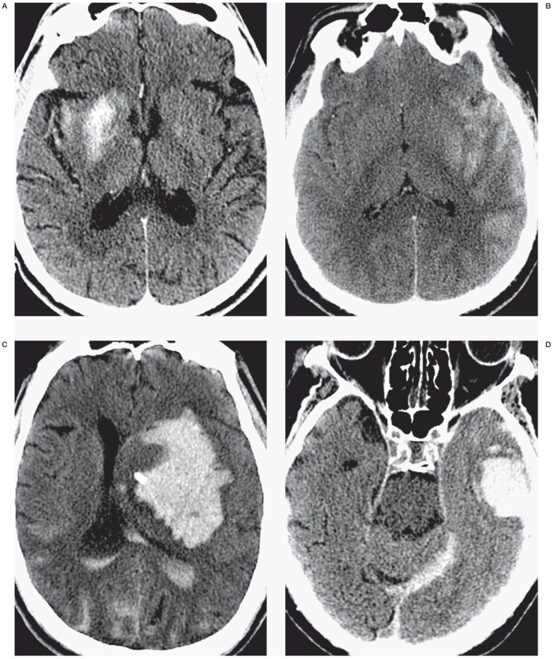 Contrast Staining on CT after DSA in Ischemic Stroke Patients ...