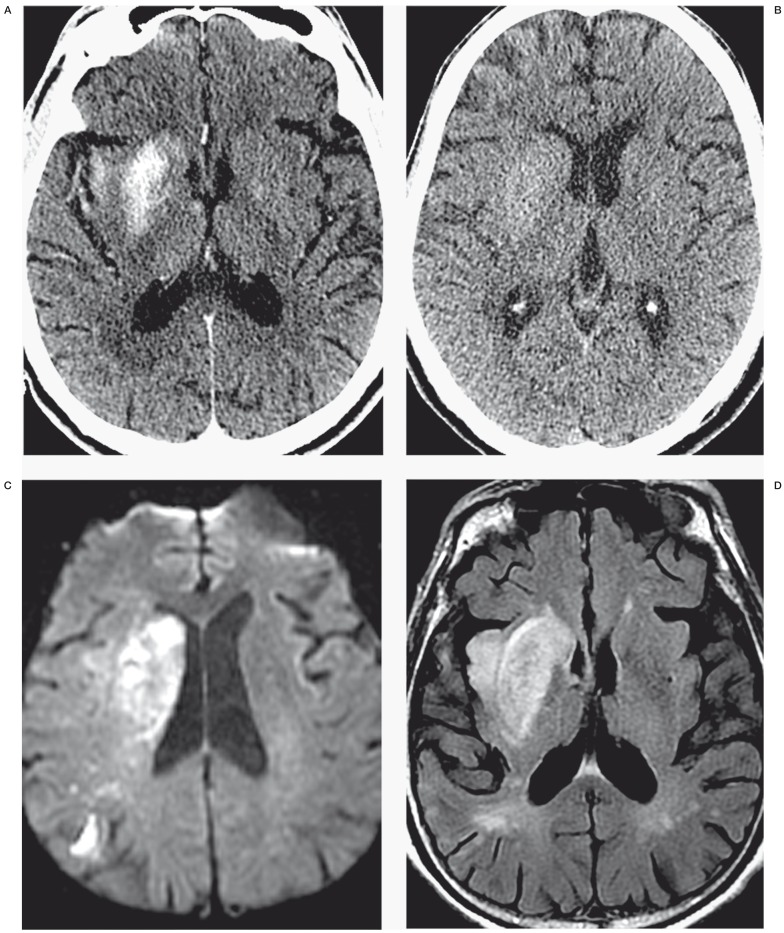 Contrast Staining on CT after DSA in Ischemic Stroke Patients ...