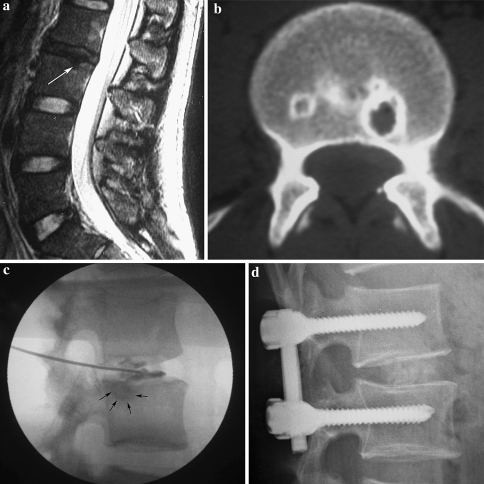 Diagnosis and surgical treatment of back pain originating from endplate ...