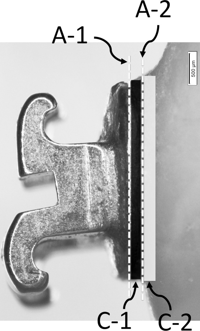 Figure 1. Diagram showing failure mode identification. Adhesive failures: Type A-1, bracket/adhesive, type A-2, adhesive/enamel. Cohesive failures: type C-1, within the adhesive layer, type C-2, within enamel. Mixed mode failures: a combination of adhesive and cohesive failures.