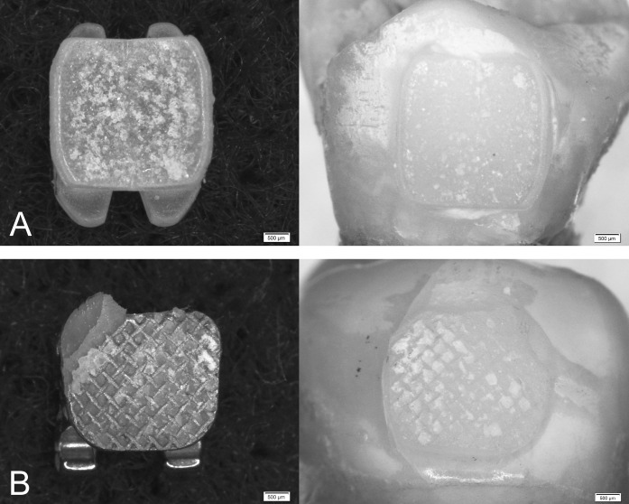 Figure 2. (A) Debonded ceramic bracket showing cohesive failure in the adhesive layer and the corresponding debonded enamel surface. (B) Debonded metal bracket with mixed failure mode (A-1, C-1, A-2) and the corresponding debonded enamel surface.