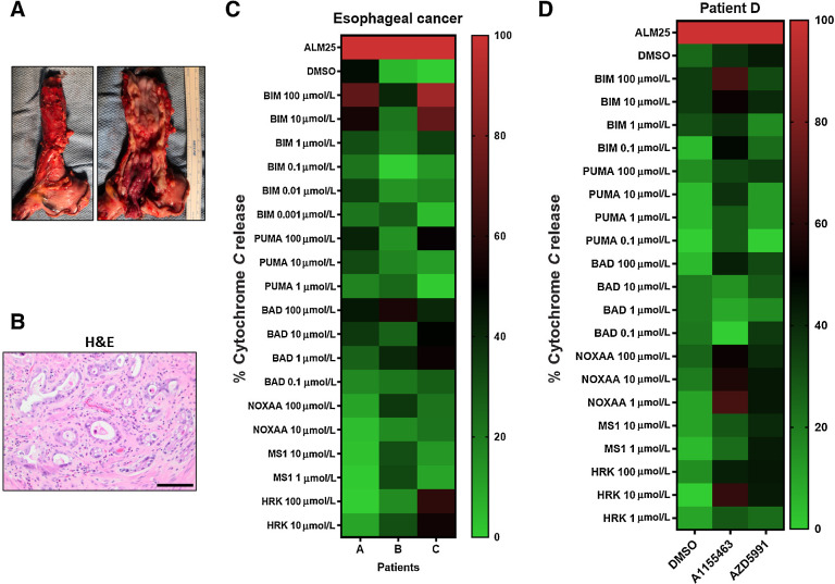 Figure 5. BH3 profiling in patients with EAC. A, An EAC of the distal esophagus after surgery. Left, The gross appearance of the intact esophagus. Right, The mucosal surface with the tumor. B, H&E staining of the resected specimen shows atypical cytologic features including increased nuclear/cytoplasmic ratio, pleomorphism, prominent nucleoli, and intraluminal necrotic debris (scale bar  = 200 μmol/L). C, Heatmap showing BH3 profilings in three patients with EAC. D, DBP with 0.2 μmol/L A1155463 and AZD5991 for 20 hours ex vivo from a metastatic pleural implant that was not radiated with the primary esophageal tumor.