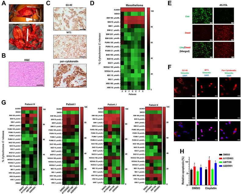 Figure 4. DBP in mesothelioma tumor specimens reveals patient-specific responses. A, Top, shows gross findings of the MPM during surgery. Bottom, shows the appearance of mesothelioma once removed. B, H&E staining of the resected specimen shows epithelioid component with tubule formation and solid architecture (scale bar  = 200 μmol/L). C, Representative results of D2-40, pan-cytokeratin, and WT1 IHC staining on MPM specimens establish the diagnosis and correlate to surface markers used for FACS analysis (scale bar  = 200 μmol/L). D, Heatmap showing BH3 profiling in seven patients reveal patient-specific profiles. E, A LIVE/DEAD assay performed in ex vivo cultured tumor cells after surgery 48 hours with 4% PFA fixed cells for positive control. Green fluorescence denotes viable cells stained with calcein-AM, while reddish-orange fluorescence represents dead cells stained with ethidium homodimer. F, Immunofluorescence double staining of pan-cytokeratin, D2-40, and WT1 (red) and vimentin (green) in ex vivo cultured patient K tumor cells (scale bar  = 200 μmol/L). G, DBP performed in four patient tumors with 0.2 μmol/L A1155463, AZD5991, and ABT-199 for 20 hours ex vivo. H, An annexin V assay reveals that pretreatment with 0.2 μmol/L A1155463, AZD5991, and ABT199 for 24 hours prior to 48 hours of CDDP treatment primed the mitochondria as noted by the apoptotic ratios. Cells positive for annexin V staining were counted as apoptotic cells (*, P < 0.05 for treatment vs. DMSO; #, P < 0.05 for combination treatment vs. A1155463, ABT-199 or S63845 single treatment).