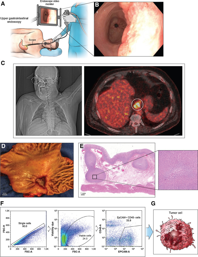 Figure 6. Schema of cancer cell isolation from patient. A, An endoscopy procedure involves inserting a long, flexible tube (endoscope) down the throat and into the esophagus. A camera on the end of the endoscope shows the esophagus. B, Endoscopic view of EAC. C, Positron emission tomography of EAC shows high glucose uptake. D, Appearance of esophagus after surgery. E, H&E staining of the resected specimen. A magnified view of black-boxed area reveals large tumor nest. F and G, Flow cytometry analysis of cancer cell subsets isolates single cancer cell suspensions labeled with cell surface markers produce distinguishable BH3 profiles upon gating.