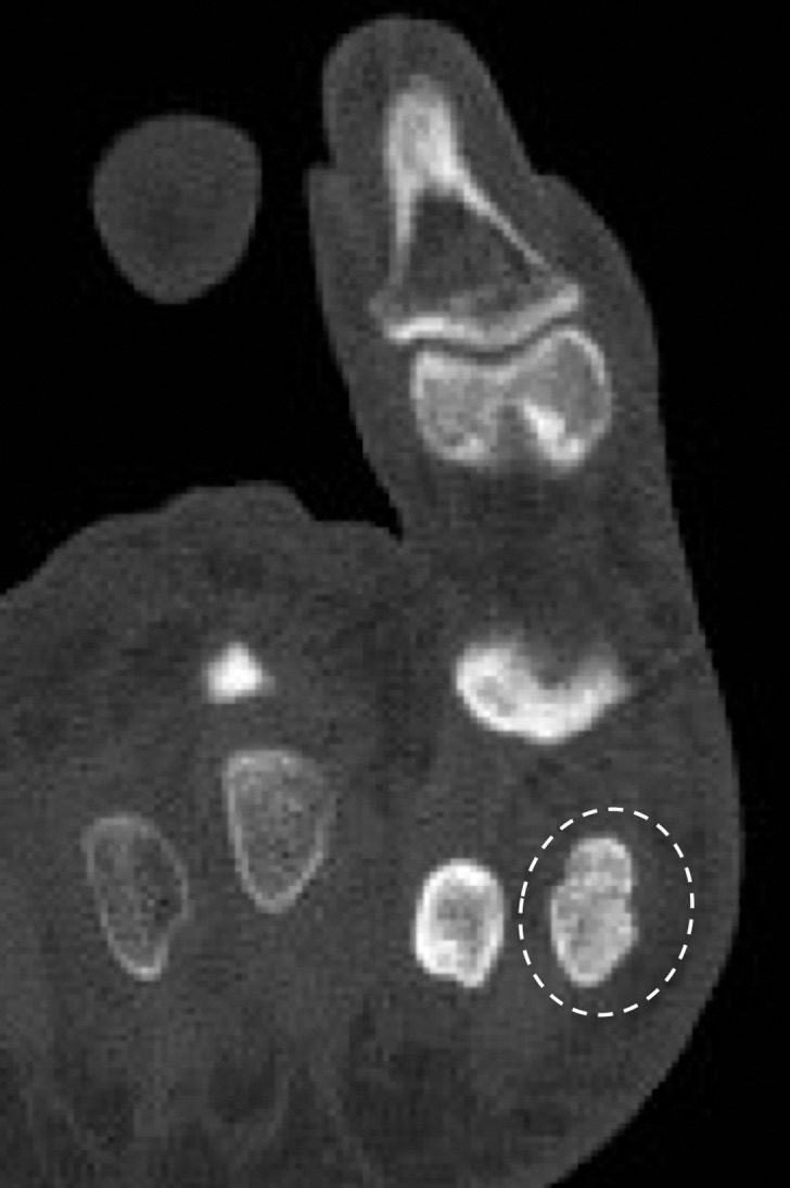 Sesamoid fracture. (a, b) Medial sesamoid fracture in a 32-year-old man after a fall. Axial T2-weighted FS (a) and sagittal PDW (b) images show an irregular cleft through the medial sesamoid with edema at the bony fragments and mild displacement likely caused by a fracture (solid white arrow). An intact medial SPL is apparent (dotted arrow). Differentiating a bipartite sesamoid from a fracture can be challenging. Irregular margins, displacement of the bony components, and a clear history of trauma are more suggestive of a fracture. Radiographs can be useful in assessment and follow-up, but radiographs were not available in this patient. L = lateral sesamoid. (c) Dorsoplantar radiograph in a 49-year-old woman with trauma to the medial sesamoid shows a cleft at the medial sesamoid with slightly irregular margins and no rounded waist (dashed circle). These imaging features are more suggestive of a fracture. (d, e) Dorsoplantar radiograph (d) obtained at 1-year follow-up and axial CT image (e) show interval osseous bridging due to healing. (f) Medial oblique radiograph in a 24-year-old woman shows an irregular fracture of the proximal lateral sesamoid (arrowhead) associated with a dislocation at the first MTPJ due to a motor vehicle accident.