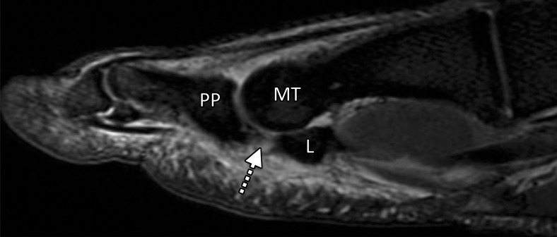 Turf toe in a 24-year-old professional football player. (a, b) Sagittal PDW (a) and sagittal PDW FS (b) images show complete tearing of the lateral SPL (arrow). Complete tearing of the medial SPL was also present (not shown). Slight proximal migration of the lateral (L) and medial (M) sesamoids is noted on the static MR images (a–c). MT = first metatarsal, PP = first proximal phalanx. (c) Axial (long-axis) PDW FS image shows marked edema at the plantar plate complex and lateral (dotted arrow) and medial (solid arrow) SPLs. (d) Lateral dynamic dorsiflexed radiograph of both feet shows proximal medial and lateral sesamoid migration in the right foot because of SPL tearing.