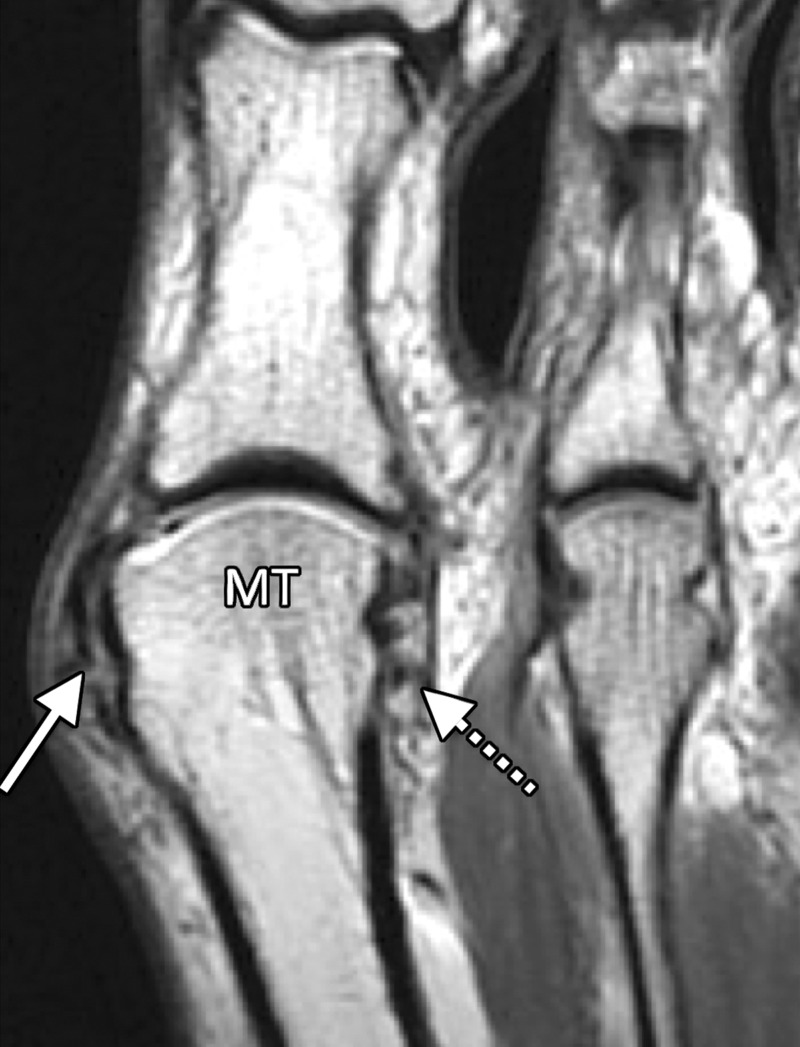 Collateral ligament tears and predislocation syndrome. Axial PDW (a) and coronal T2-weighted FS (b) images show hallux valgus with partial tears of the medial (solid arrow) and lateral (dotted arrow) collateral ligaments with first MTPJ degenerative changes. Capsular thickening and surrounding edema (arrowheads) are seen at the second MTPJ. These imaging features are consistent with adhesive capsulitis, which in association with hallux valgus is termed predislocation syndrome. As the name implies, if the underlying biomechanical abnormality is not corrected, the second MTPJ plantar plate will tear, resulting in instability and eventual dislocation. MT = first metatarsal.