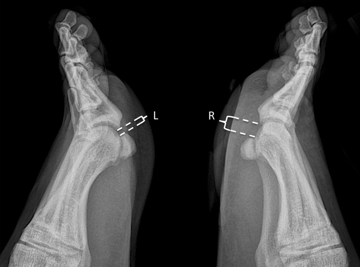 Turf toe in a 24-year-old professional football player. (a, b) Sagittal PDW (a) and sagittal PDW FS (b) images show complete tearing of the lateral SPL (arrow). Complete tearing of the medial SPL was also present (not shown). Slight proximal migration of the lateral (L) and medial (M) sesamoids is noted on the static MR images (a–c). MT = first metatarsal, PP = first proximal phalanx. (c) Axial (long-axis) PDW FS image shows marked edema at the plantar plate complex and lateral (dotted arrow) and medial (solid arrow) SPLs. (d) Lateral dynamic dorsiflexed radiograph of both feet shows proximal medial and lateral sesamoid migration in the right foot because of SPL tearing.