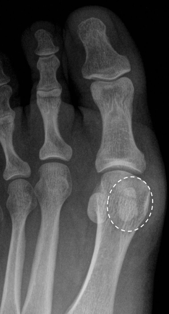 Sesamoid fracture. (a, b) Medial sesamoid fracture in a 32-year-old man after a fall. Axial T2-weighted FS (a) and sagittal PDW (b) images show an irregular cleft through the medial sesamoid with edema at the bony fragments and mild displacement likely caused by a fracture (solid white arrow). An intact medial SPL is apparent (dotted arrow). Differentiating a bipartite sesamoid from a fracture can be challenging. Irregular margins, displacement of the bony components, and a clear history of trauma are more suggestive of a fracture. Radiographs can be useful in assessment and follow-up, but radiographs were not available in this patient. L = lateral sesamoid. (c) Dorsoplantar radiograph in a 49-year-old woman with trauma to the medial sesamoid shows a cleft at the medial sesamoid with slightly irregular margins and no rounded waist (dashed circle). These imaging features are more suggestive of a fracture. (d, e) Dorsoplantar radiograph (d) obtained at 1-year follow-up and axial CT image (e) show interval osseous bridging due to healing. (f) Medial oblique radiograph in a 24-year-old woman shows an irregular fracture of the proximal lateral sesamoid (arrowhead) associated with a dislocation at the first MTPJ due to a motor vehicle accident.