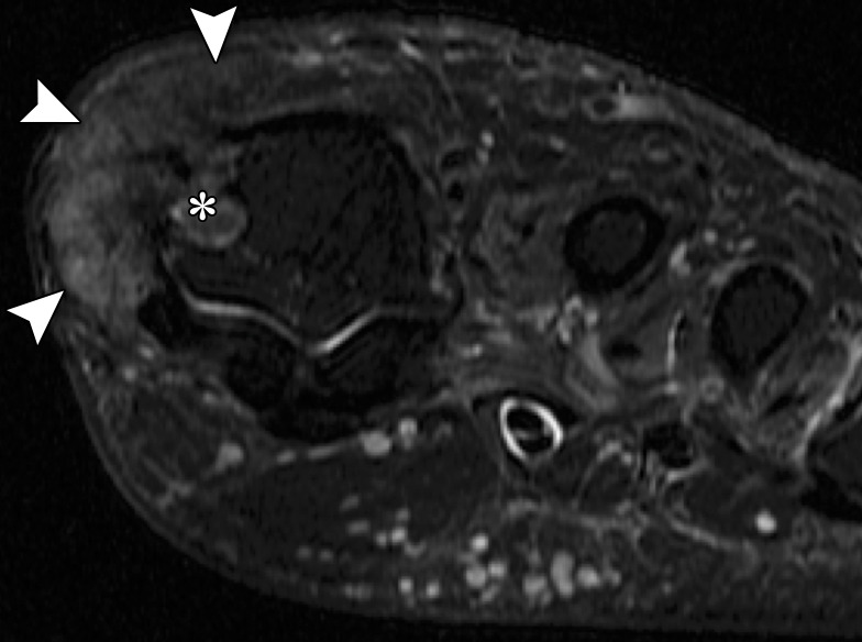 Gouty arthropathy at the first MTPJ in a 73-year-old man with left hallux valgus and first MTPJ pain and swelling. Coronal T2-weighted FS (a) and axial PDW (b) images show first MTPJ degenerative changes with a heterogeneous-signal-intensity soft-tissue mass medially (arrowheads) and bony erosion at the first metatarsal head (*). The underlying medial collateral ligament is poorly visualized, and there is a large proximal phalangeal cyst (dotted arrow) extending from the joint. These findings are compatible with a gouty tophus and intra-articular involvement.