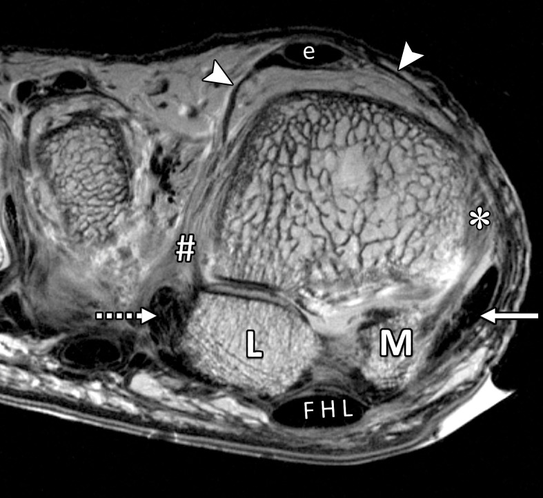 Musculotendinous structures of the first MTPJ. Coronal PDW images (2000/35) of the metatarsosesamoid joint (a) and the distal first metatarsal (MT) (b) depict the attachment of the adductor (dotted arrow) and abductor (solid arrow) hallucis tendons to the lateral (L) and medial (M) sesamoids. These tendons insert in close relation to the lateral (#) and medial (*) MTSLs and the lateral (+ = tendon, lat = muscle belly) and medial (☆) heads of the FHB. The adductor hallucis conjoint tendon is formed from the transverse (t = muscle, solid oval = tendon) and oblique (o = muscle, dashed oval = tendon) heads. Dorsally, the extensor tendons (e) can be seen secured by the lateral and medial sagittal bands (arrowheads).