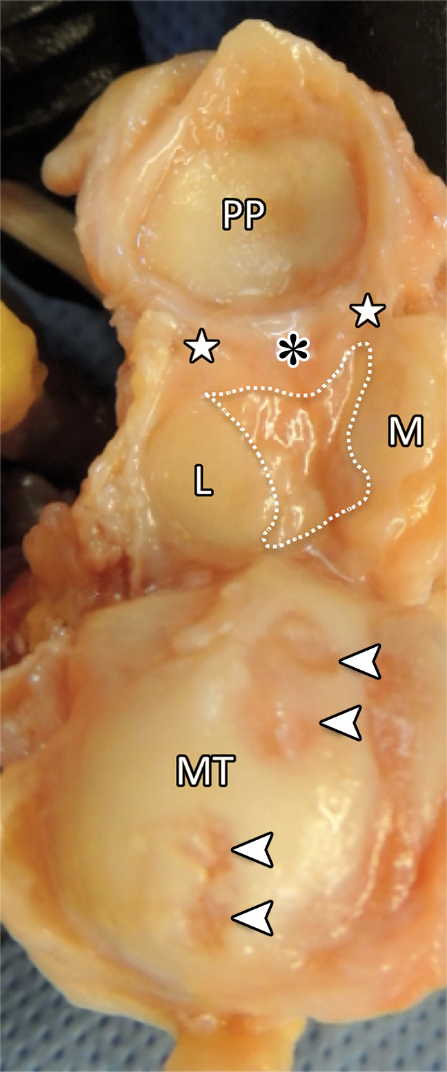 First MTPJ anatomy. (a) Drawing depicts a view from below the first MTPJ musculotendinous structures. Laterally, the oblique (ADo) and transverse (ADt) heads of the adductor hallucis provide resistance to medial displacement. Medially, the abductor hallucis tendon (AB) inserts at the medial sesamoid (M) and medial capsuloligamentous structures, preventing hallux valgus. The lateral (FHBl) and medial (FHBm) heads of the FHB insert at the respective sesamoids, preventing distal sesamoid migration. Inset in a shows the MTPJ with the FHL and tendons removed. IS = intersesamoid ligament. (b, c) Gross anatomy of a cadaveric first MTPJ specimen (b) is also shown with the medial structures dissected and then with plantar disarticulation, with the plantar plate complex (c) viewed from the dorsal aspect. Paired SPLs (☆) and the medial SPL (arrow in b) are continuous with the capsule and fibrocartilaginous pad (*), preventing proximal sesamoid migration. The ISL (dotted line in c) prevents sesamoid splaying. Chondral defects are noted at the metatarsal head (arrowheads in c). L = lateral sesamoid, MT = metatarsal, PP = proximal phalanx.