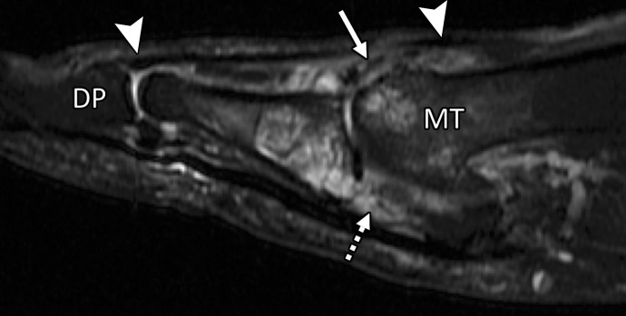 Extensor tendon injury in a 70-year-old woman after resection of dorsal first MTPJ osteophytes (cheilectomy). Coronal PDW (a) and sagittal T2-weighted FS (b) images show partial tearing of the extensor tendons at the level of the metatarsal (MT) head, most marked at the EHB (solid white arrow) near the proximal phalanx insertion, with less marked changes at the EHL with an intact distal phalanx (DP) insertion (arrowheads). The dorsal medial sagittal band (black arrow) is partly torn with first MTPJ degeneration and subchondral cysts, along with tearing of the plantar plate complex distally (dotted arrow).