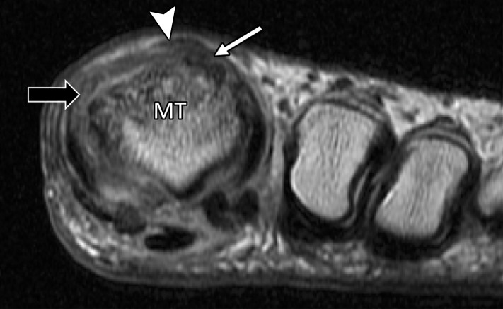 Extensor tendon injury in a 70-year-old woman after resection of dorsal first MTPJ osteophytes (cheilectomy). Coronal PDW (a) and sagittal T2-weighted FS (b) images show partial tearing of the extensor tendons at the level of the metatarsal (MT) head, most marked at the EHB (solid white arrow) near the proximal phalanx insertion, with less marked changes at the EHL with an intact distal phalanx (DP) insertion (arrowheads). The dorsal medial sagittal band (black arrow) is partly torn with first MTPJ degeneration and subchondral cysts, along with tearing of the plantar plate complex distally (dotted arrow).