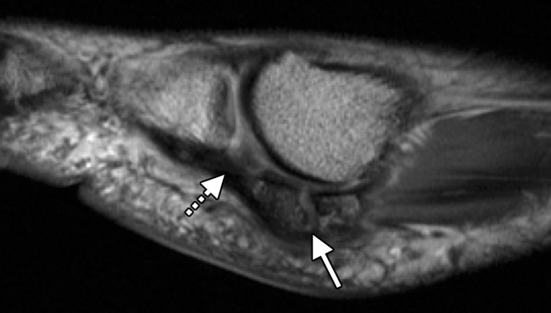 Sesamoid fracture. (a, b) Medial sesamoid fracture in a 32-year-old man after a fall. Axial T2-weighted FS (a) and sagittal PDW (b) images show an irregular cleft through the medial sesamoid with edema at the bony fragments and mild displacement likely caused by a fracture (solid white arrow). An intact medial SPL is apparent (dotted arrow). Differentiating a bipartite sesamoid from a fracture can be challenging. Irregular margins, displacement of the bony components, and a clear history of trauma are more suggestive of a fracture. Radiographs can be useful in assessment and follow-up, but radiographs were not available in this patient. L = lateral sesamoid. (c) Dorsoplantar radiograph in a 49-year-old woman with trauma to the medial sesamoid shows a cleft at the medial sesamoid with slightly irregular margins and no rounded waist (dashed circle). These imaging features are more suggestive of a fracture. (d, e) Dorsoplantar radiograph (d) obtained at 1-year follow-up and axial CT image (e) show interval osseous bridging due to healing. (f) Medial oblique radiograph in a 24-year-old woman shows an irregular fracture of the proximal lateral sesamoid (arrowhead) associated with a dislocation at the first MTPJ due to a motor vehicle accident.