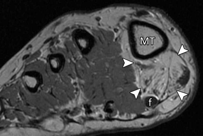 Lateral MTSL tear in a 54-year-old woman with right hallux valgus and first web space pain. Coronal T2-weighted FS (a) and PDW (b) images show chondral loss at the lateral sesamoid (*) and first metatarsal articulation (dashed oval). There is partial tearing of the lateral MTSL (☆) with adjacent first web space edema and adductor hallucis tendinosis (solid white arrow). Medial sagittal band tearing (dotted arrow) and mild lateral subluxation of the extensor tendons (black arrow) are due to underlying hallux valgus. There is atrophy of the abductor hallucis and the FHB muscles (arrowheads) due to long-standing hallux valgus deformity. f = flexor hallucis longus tendon, MT = first metatarsal.