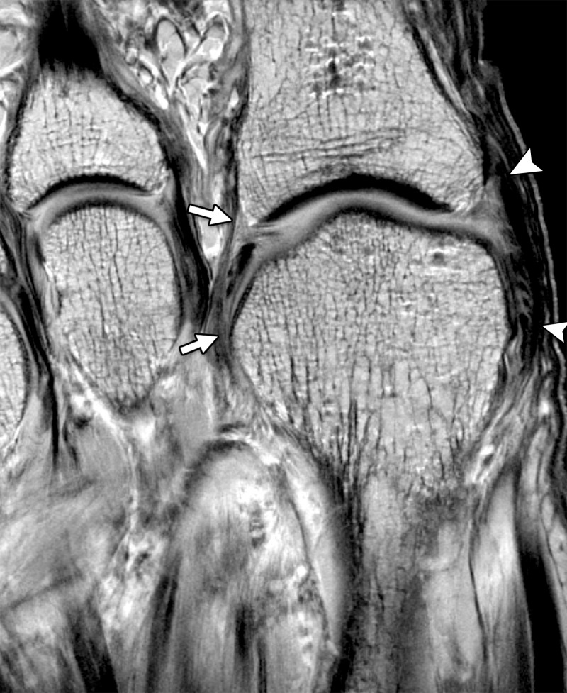 Axial (long-axis) PDW image (2000/35) shows the first MTPJ collateral ligaments. Lateral (arrows) and medial (arrowheads) collateral ligaments resist varus and valgus first MTPJ forces, respectively.