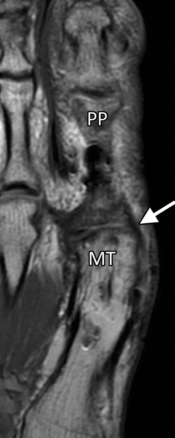 Treatment for hallux valgus. Axial PDW (a), coronal T2-weighted FS (b), and sagittal PDW (c) images in a 37-year-old man with reduced extension at the right first MTPJ who had hallux valgus corrective surgery 17 years earlier and hardware removed 1 year before. Postoperative changes and metallic artifacts are seen at the first metatarsal (MT) and proximal phalanx (PP) because of osteotomies. There is thickening of the medial collateral ligament (white arrow) and MTSL (☆) with postsurgical fibrosis appearing as low signal intensity along an attenuated medial sagittal band (arrowheads). Lateralization and tendinosis of the extensor tendons (black arrow) with underlying synovitis, fibrosis, and capsulitis (*) lead to reduced extension. The medial SPL (dotted arrow) shows only mild degeneration. L = lateral sesamoid, M = medial sesamoid.