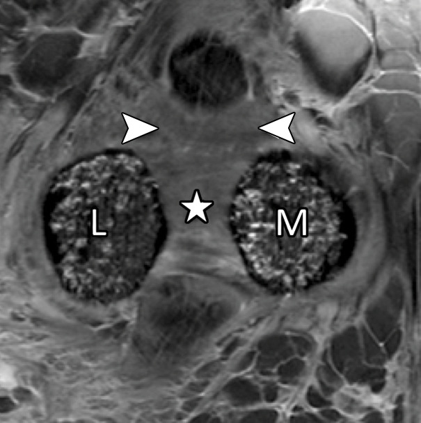 First MTPJ anatomy in a cadaveric specimen. Axial (a), central sagittal (b), and medial sagittal (c) gradient-echo images (5000/10) show how the lateral (L) and medial (M) sesamoids are connected by the ISL (☆). A fibrocartilaginous pad (arrowheads) is seen distal to the ISL, which merges with the medial SPL (black arrow) and lateral SPL (not shown). Dorsally, the EHB tendon (dotted arrow) attaches to the proximal phalanx and lies deep to the EHL tendon (white arrow).