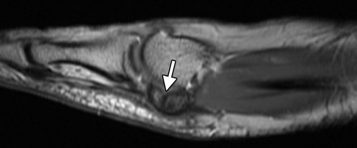 Bipartite sesamoiditis. (a–c) Axial (a) and sagittal T2-weighted FS (b) and sagittal (c) PDW images show medial sesamoiditis in a 24-year-old woman with pain at the plantar aspect of the right first MTPJ. There is a bifid appearance of the medial sesamoid with marrow edema (solid arrow in a and b) at both components. Smooth corticated margins and the presence of a waist at the superior margin of the sesamoid (arrow in c) are more suggestive of bipartite sesamoiditis rather than a fracture. Partial tearing of the medial SPL is also seen (dotted arrow). Radiographs were not available in this patient but are useful for assessment and follow-up. L = lateral sesamoid. (d, e) Dorsoplantar (d) and lateral (e) radiographs in a 15-year-old patient with plantar trauma show separation of two components at the medial sesamoid (dashed circles). This was a challenging case, with the proximal rounded margins of the distal component (arrowhead) suggestive of diastasis of a bipartite sesamoid rather than a fracture. Despite the challenges in differentiating the two conditions, fracture and diastasis are treated similarly with initial conservative management.