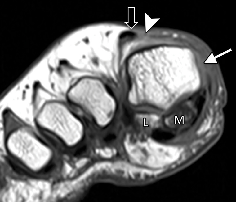 Skimboarder toe. Coronal T1-weighted (a) and T2-weighted FS (b) images show high-grade tearing of the medial sagittal band (arrowhead) and lateral subluxation of the extensor tendons (black arrow) due to forced hyperextension. Tearing of the medial capsular structures and collateral ligament is noted (white arrow) with additional medial sesamoiditis or degeneration. Skimboarders use their great toe for traction when mounting their waxed boards. The board can slip posteriorly, leading to forced first MTPJ hyperextension. L = lateral, M = medial.