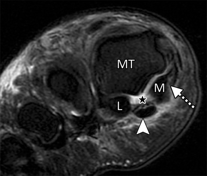 Turf toe in a 28-year-old professional American football player. Arrowheads = FHL, MT = first metatarsal. (a) Sagittal PDW FS image of the right first MTPJ shows complete tearing of the medial SPL (arrow). Additional high-grade tearing of the lateral SPL was apparent (not shown). PP = first proximal phalanx. (b, c) Coronal PDW FS images of the lateral (L) and medial (M) sesamoids (b) and just distal to the sesamoids (c) show the medial SPL tear extending into the ISL (★) and central plantar plate (*). Partial tearing of the medial MTSL (dotted arrow) is also seen. (d) Lateral dynamic dorsiflexed radiograph of both feet shows increased proximal migration of the right medial sesamoid compared to the left medial sesamoid. The medial sesamoids and proximal phalanges are outlined (dashed lines).