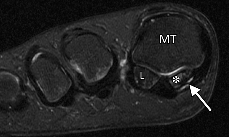 Medial MTSL tear in a 21-year-old man. Coronal (a) and axial (b) T2-weighted FS images show mild chondral loss (*) at the medial sesamoid and metatarsal head articulation. Partial tearing of the medial MTSL and capsular structures is seen with a fluid cleft at the sesamoid insertion (arrow). Thickening and altered signal intensity of the medial head of the FHB and abductor hallucis tendons (arrowhead) is compatible with tendinosis. These medial plantar structures interlink to prevent hallux valgus. L = lateral sesamoid, MT = first metatarsal.