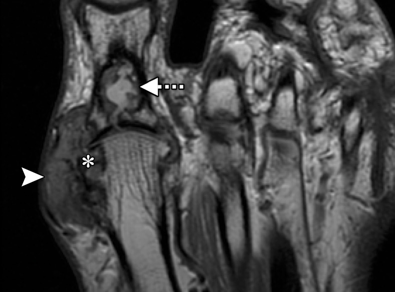 Gouty arthropathy at the first MTPJ in a 73-year-old man with left hallux valgus and first MTPJ pain and swelling. Coronal T2-weighted FS (a) and axial PDW (b) images show first MTPJ degenerative changes with a heterogeneous-signal-intensity soft-tissue mass medially (arrowheads) and bony erosion at the first metatarsal head (*). The underlying medial collateral ligament is poorly visualized, and there is a large proximal phalangeal cyst (dotted arrow) extending from the joint. These findings are compatible with a gouty tophus and intra-articular involvement.