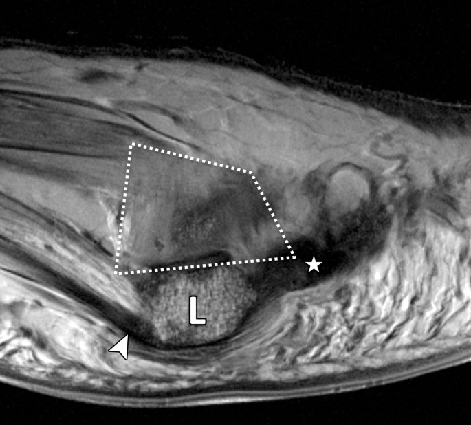 Normal anatomy of the first MTSLs. Coronal (a) and lateral sagittal (b) PDW images (2000/35) depict how the lateral (#) and medial (*) MTSLs secure the lateral (L) and medial (M) sesamoids. The MTSLs are components of the plantar plate complex and attach to the sesamoids in close relation to the FHB tendons. The insertion of the lateral head of the FHB tendon can be seen (arrowhead). The lateral MTSL inserts adjacent to the conjoint adductor hallucis tendon (dotted arrow), which resists varus stress. The medial MTSL inserts adjacent to the abductor hallucis tendon (solid arrow), which resists valgus stress. The rhomboid lateral MTSL (white dotted line in b) blends with the capsule and lateral SPL (☆). Ext = extensor tendons.