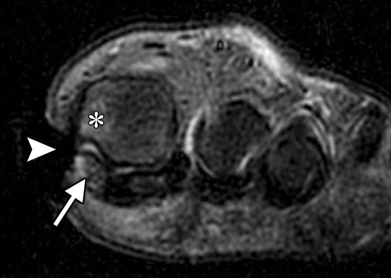 Methicillin-resistant Staphylococcus aureus (MRSA) osteomyelitis at the first MTPJ in a 70-year-old woman with a diabetic wound at the medial first toe. Coronal T1-weighted (a) and T2-weighted (b) FS images show a large soft-tissue ulcer along the medial aspect of the first MTPJ (arrowhead). There is irregularity and loss of the normal T1-weighted marrow signal at the medial sesamoid (arrow) with edema at the sesamoid and medial metatarsal head (*). These changes are suspicious for osteomyelitis. Soft-tissue swelling and edema around the first digit with a small first MTPJ effusion are also noted.