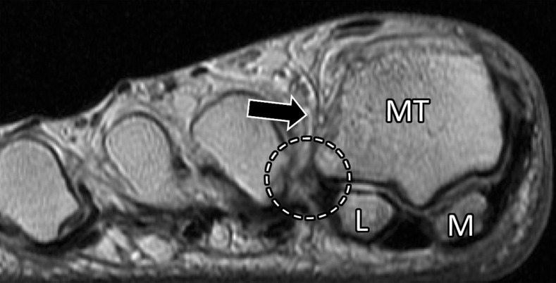 Lateral MTSL tear and adductor hallucis tendinosis and atrophy in a 69-year-old woman with hallux valgus and persistent foot pain. Coronal PDW (a, c) and T2-weighted FS (b) images show first MTPJ degenerative changes with chondral loss and subchondral edema most apparent at the lateral sesamoid (L) and metatarsal articulation. There is partial tearing of the lateral MTSL (dashed circle) and lateral collateral ligament (black arrow). More proximally in b, there is predislocation syndrome with edema surrounding the distal second (m) and third metatarsal shafts and MTPJs due to capsulitis. Tendinosis of the transverse (solid white arrow) and oblique (dotted arrow) heads of the adductor hallucis is apparent with fatty muscle atrophy (arrowheads) seen proximally in c. f = flexor hallucis longus tendon, M = medial sesamoid, MT = metatarsal.