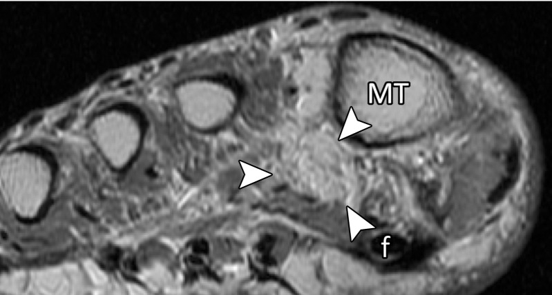 Lateral MTSL tear and adductor hallucis tendinosis and atrophy in a 69-year-old woman with hallux valgus and persistent foot pain. Coronal PDW (a, c) and T2-weighted FS (b) images show first MTPJ degenerative changes with chondral loss and subchondral edema most apparent at the lateral sesamoid (L) and metatarsal articulation. There is partial tearing of the lateral MTSL (dashed circle) and lateral collateral ligament (black arrow). More proximally in b, there is predislocation syndrome with edema surrounding the distal second (m) and third metatarsal shafts and MTPJs due to capsulitis. Tendinosis of the transverse (solid white arrow) and oblique (dotted arrow) heads of the adductor hallucis is apparent with fatty muscle atrophy (arrowheads) seen proximally in c. f = flexor hallucis longus tendon, M = medial sesamoid, MT = metatarsal.